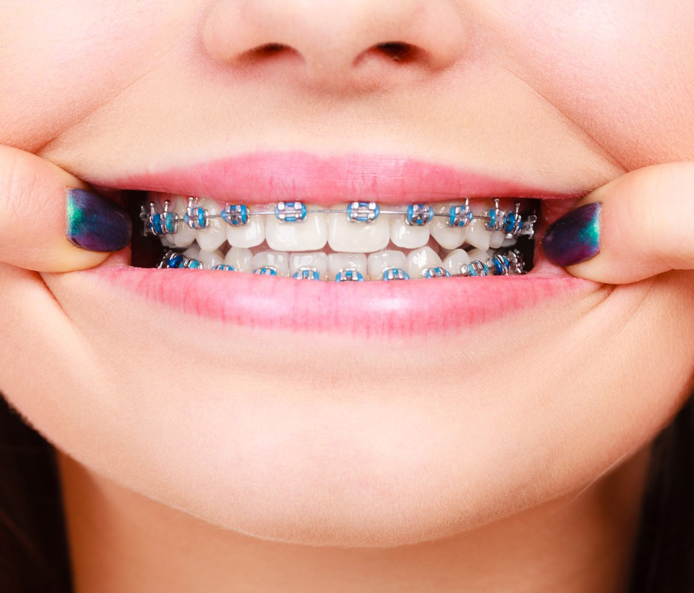 Teeth braces for adults cost